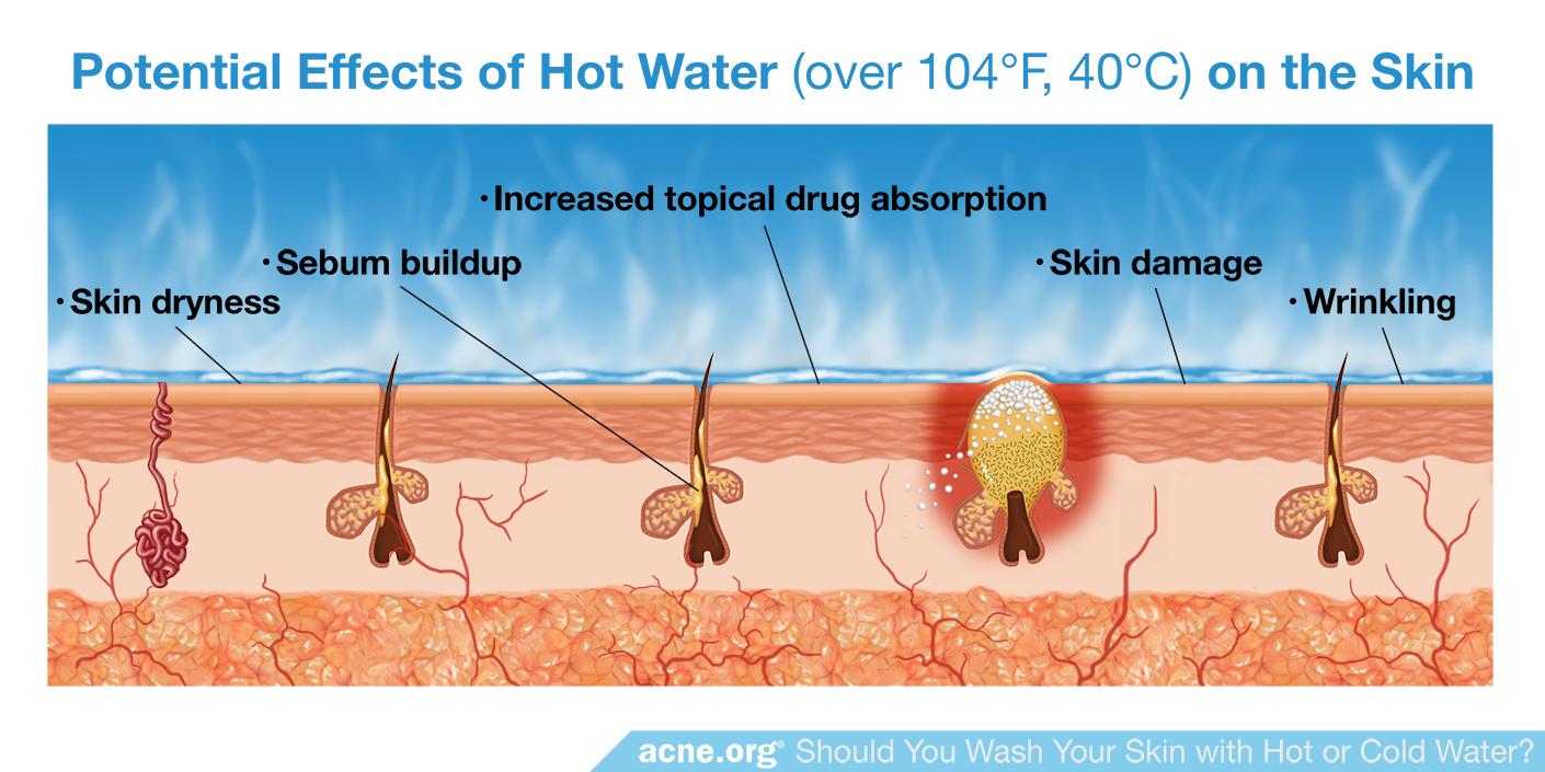 Potential Effects of Hot Water on the Skin