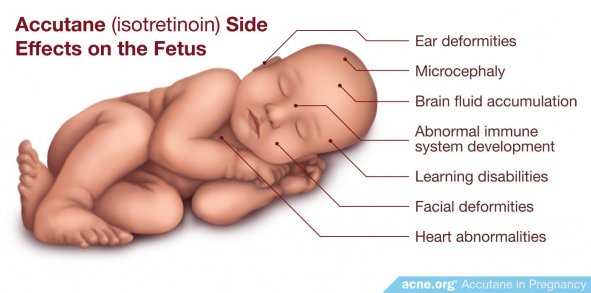 Accutane (Isotretinoin) Side Effects on the Fetus