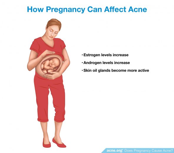 How Pregnancy Can Affect Acne