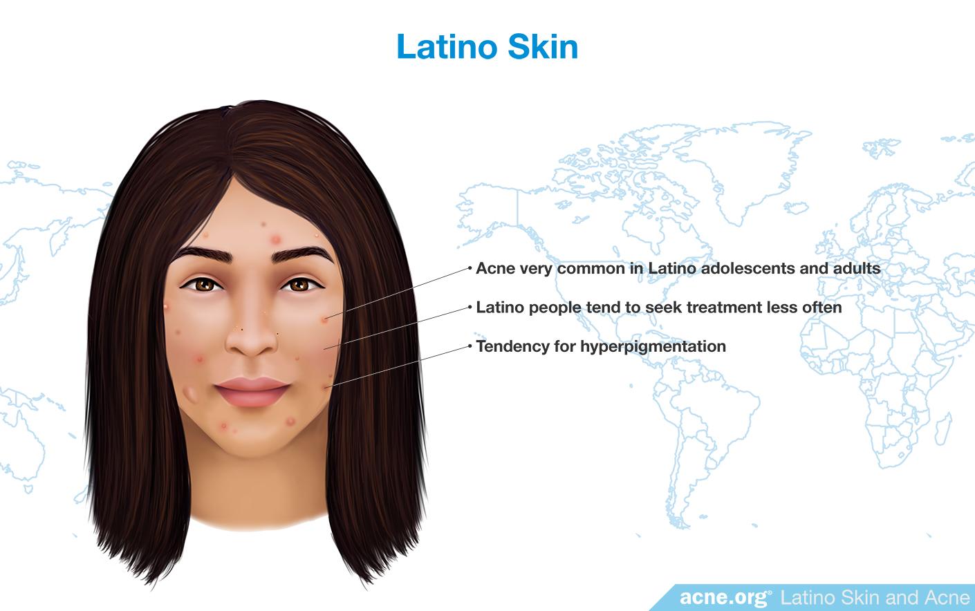 Latino Skin and Acne