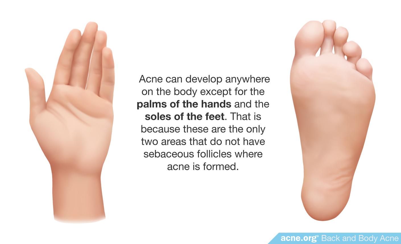 Body Acne Can Develop Anywhere