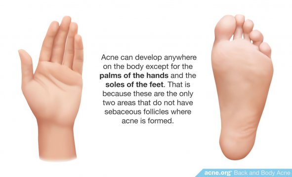 Body Acne Can Develop Anywhere