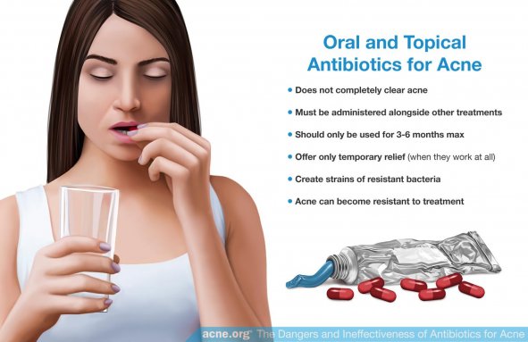 Oral and Topical Antibiotics for Acne