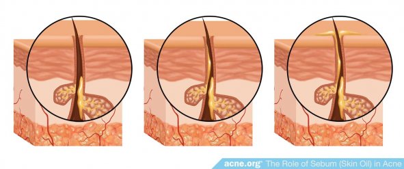 Sebum Development in the Pore