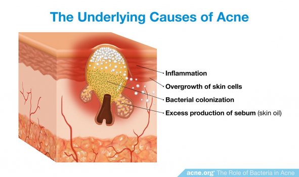 The Underlying Causes of Acne