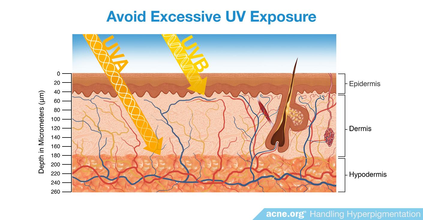 Avoid Excessive UV Exposure