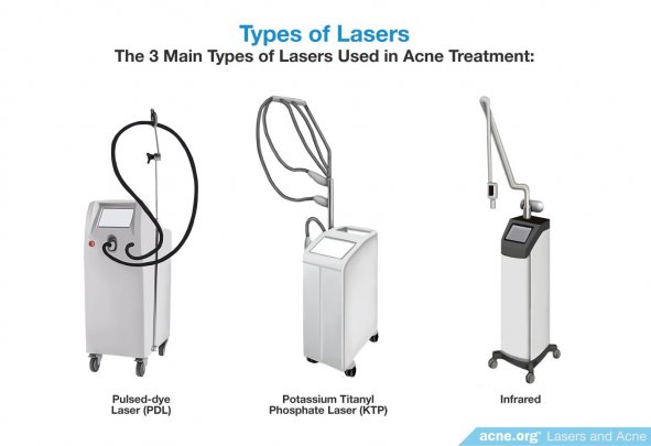 Types of Lasers