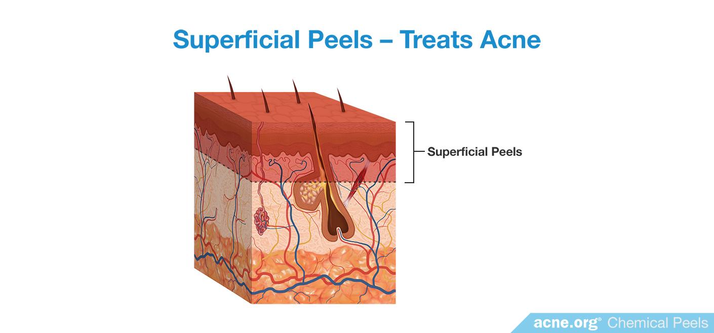 Superficial Chemical Peels - Treat Acne