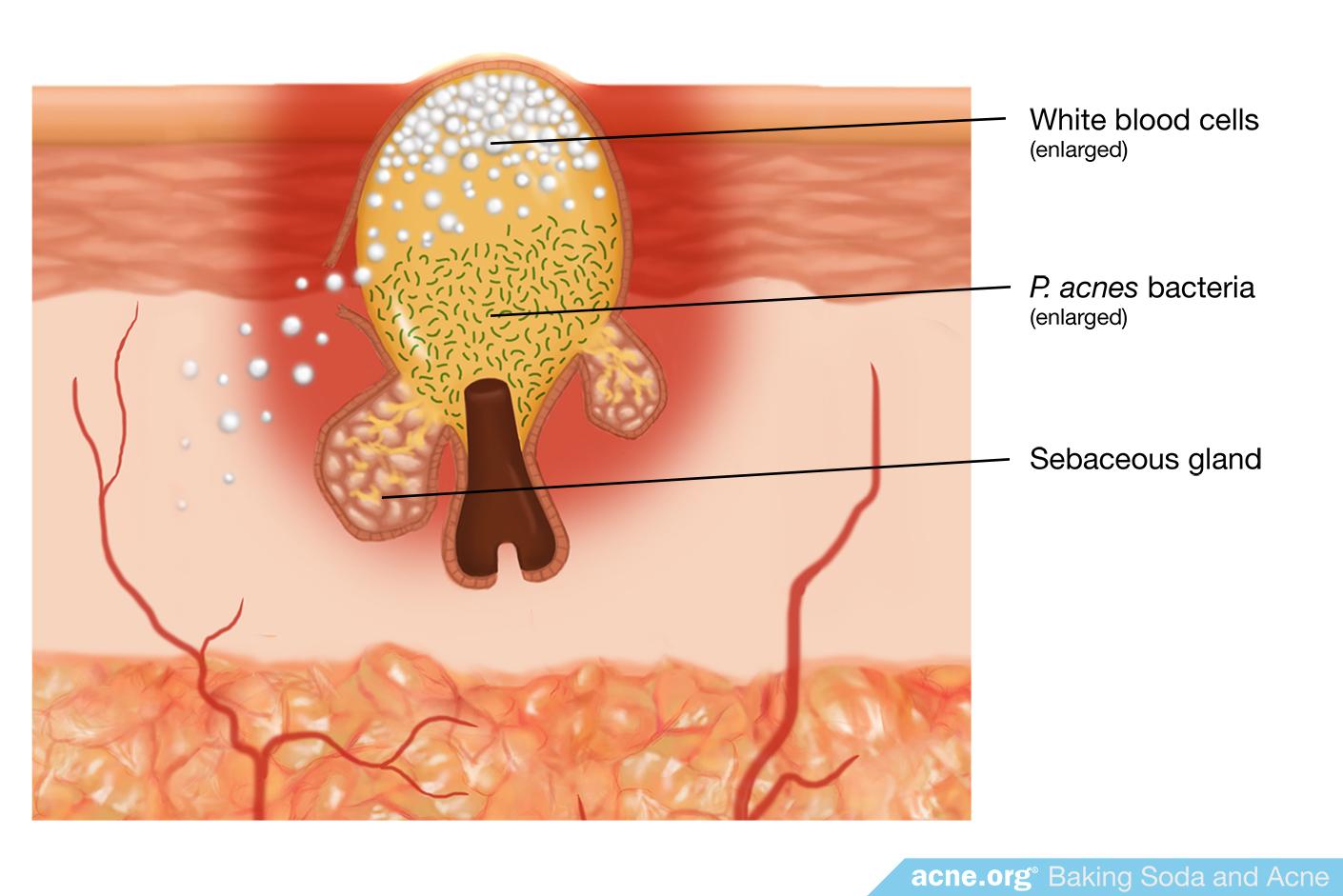 P. acnes Bacteria Inside a Skin Pore