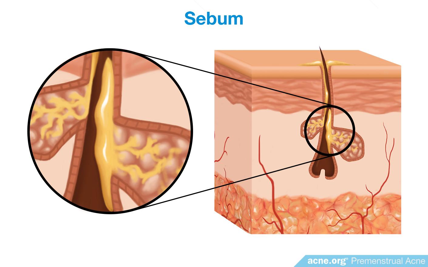 Premenstrual Acne