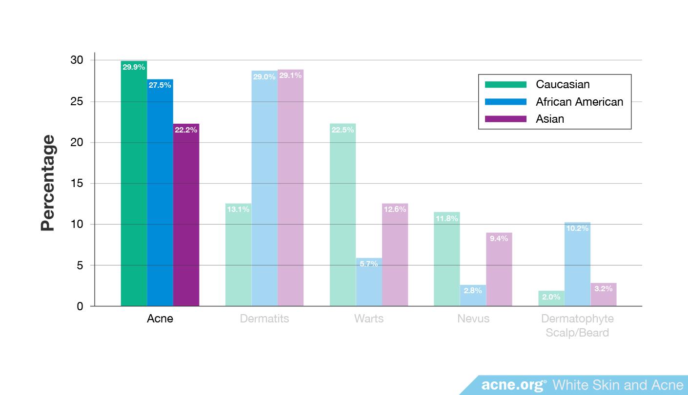Percentage of Acne by Ethnicity