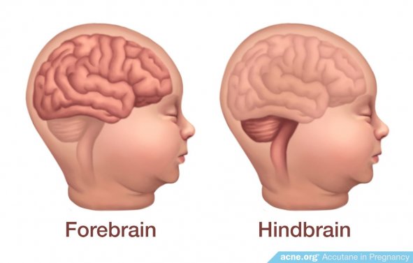 Forebrain - Hindbrain