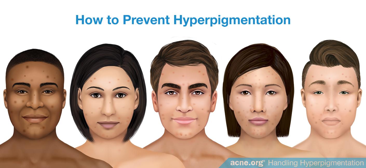 How to Prevent Hyperpigmentation