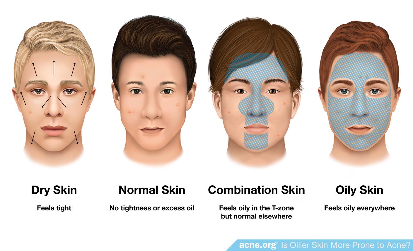 Skin Types