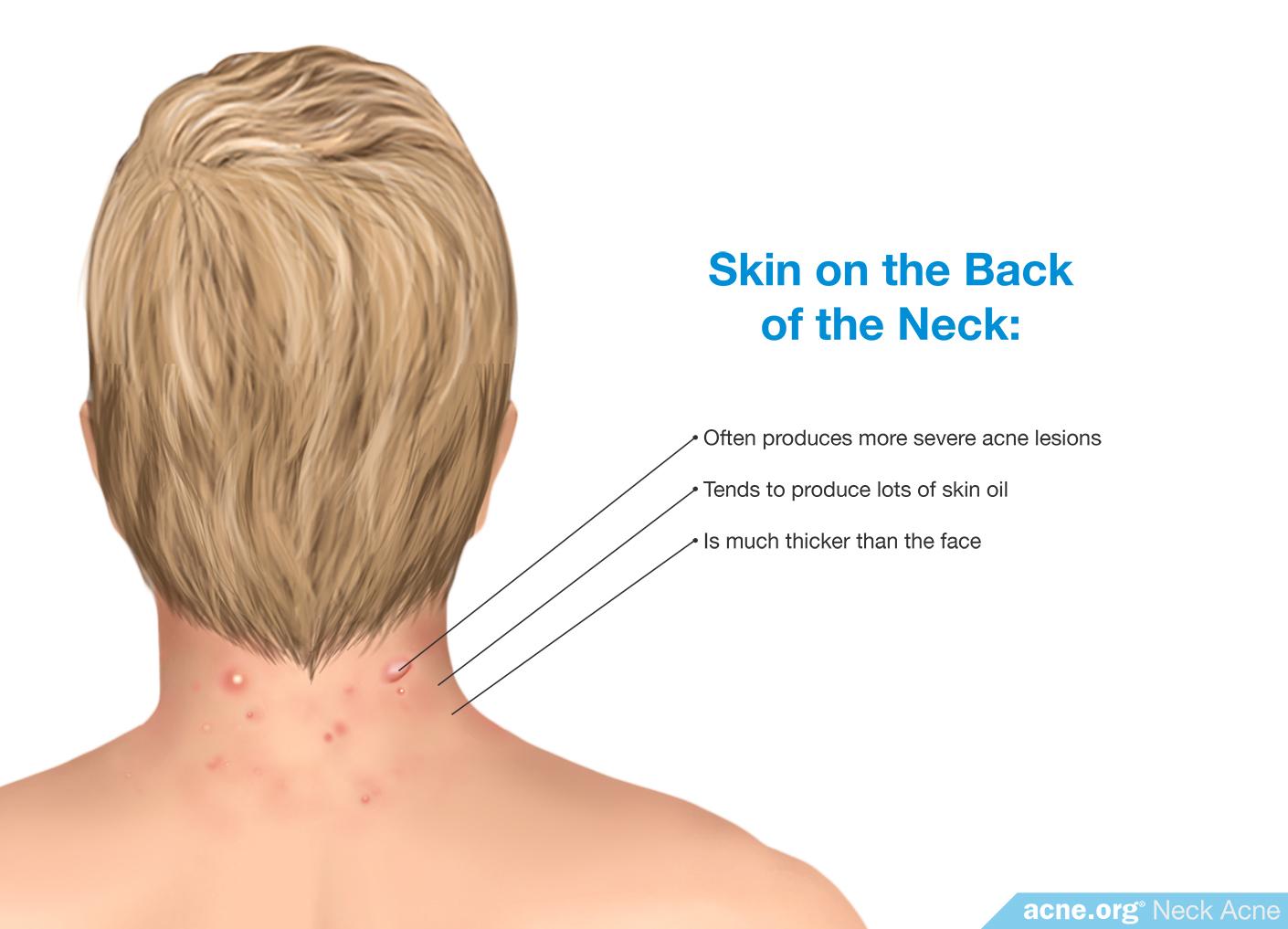 Neck Acne Treatment Acne