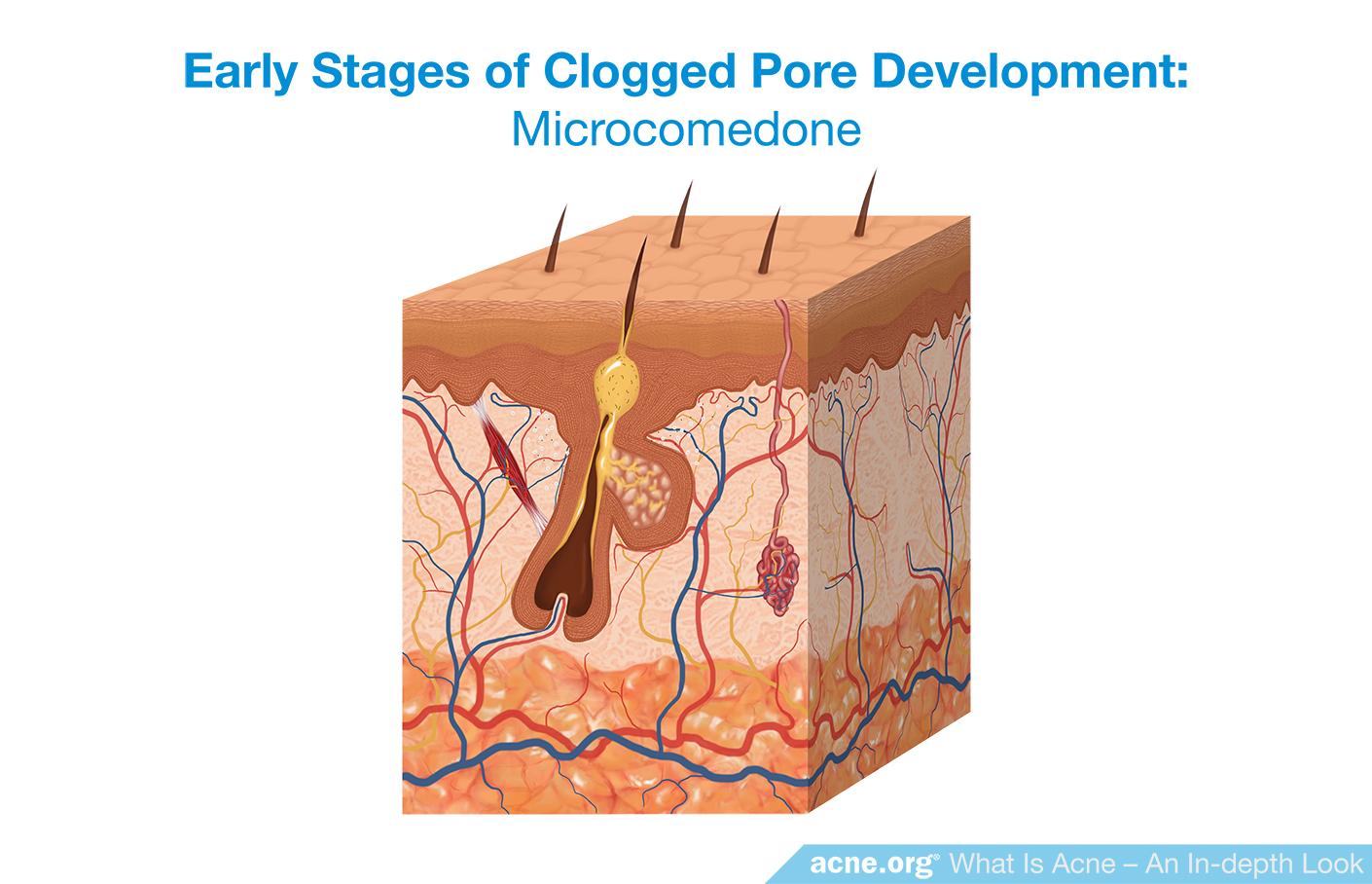 Early Stages of Clogged Pore Development: Microcomedone