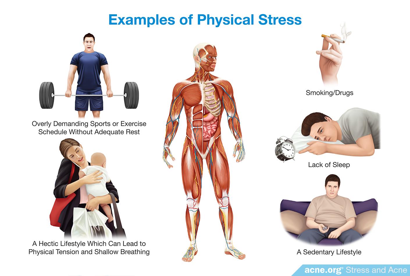 Examples of Physical Stress