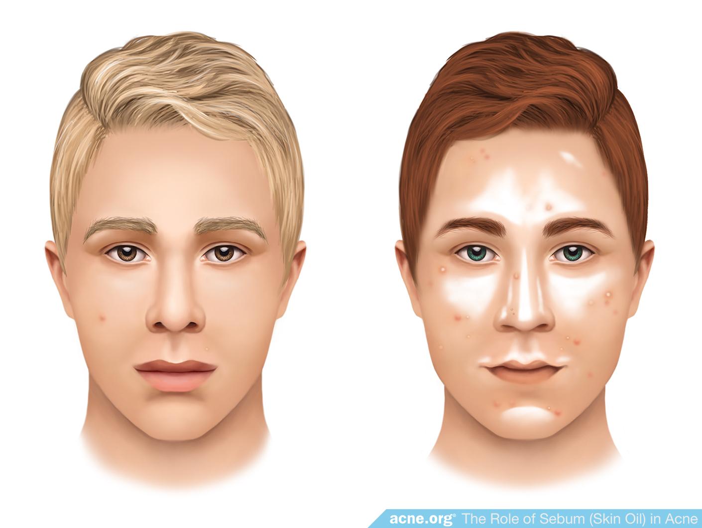 Sebum Levels in Acne Patients
