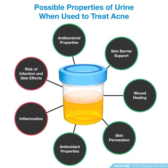 Possible Properties of Urine When Used to Treat Acne