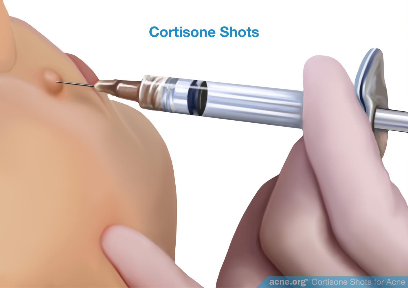 Cortisone Shots