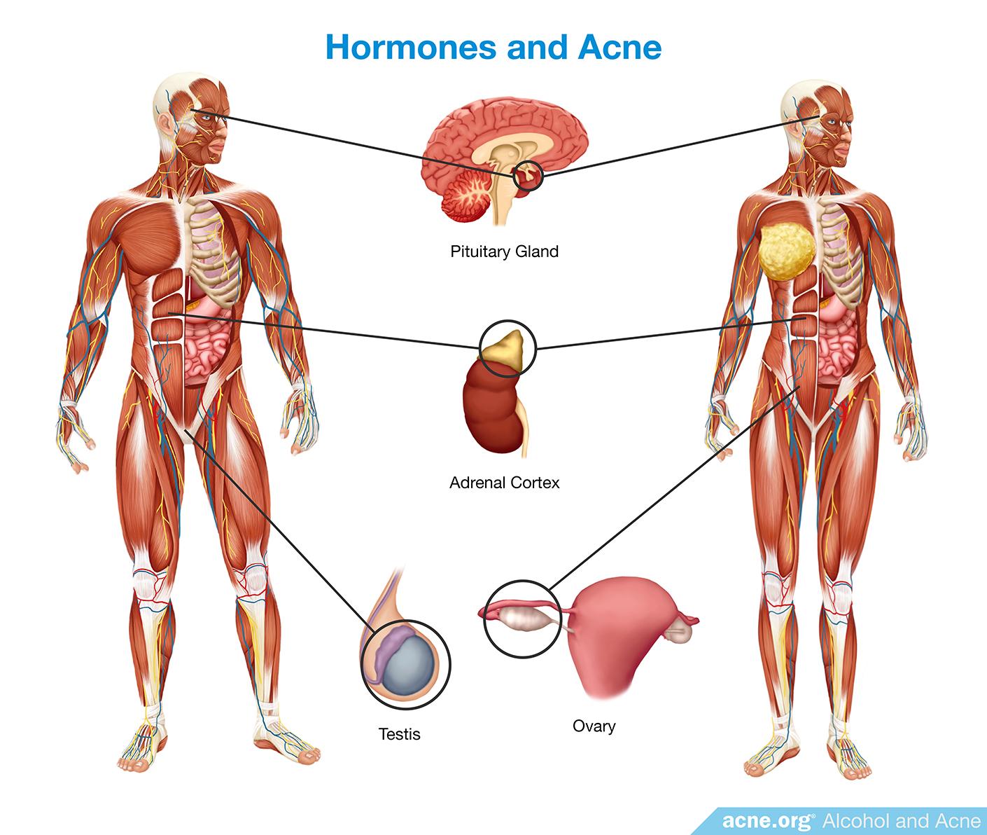 Hormones and Acne