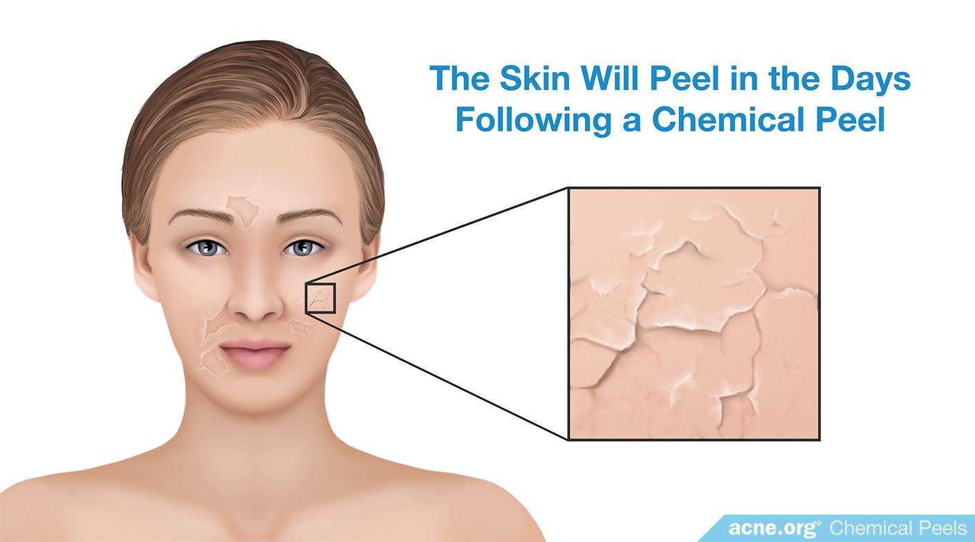 The Skin Will Peel in the Days Following a Chemical Peel