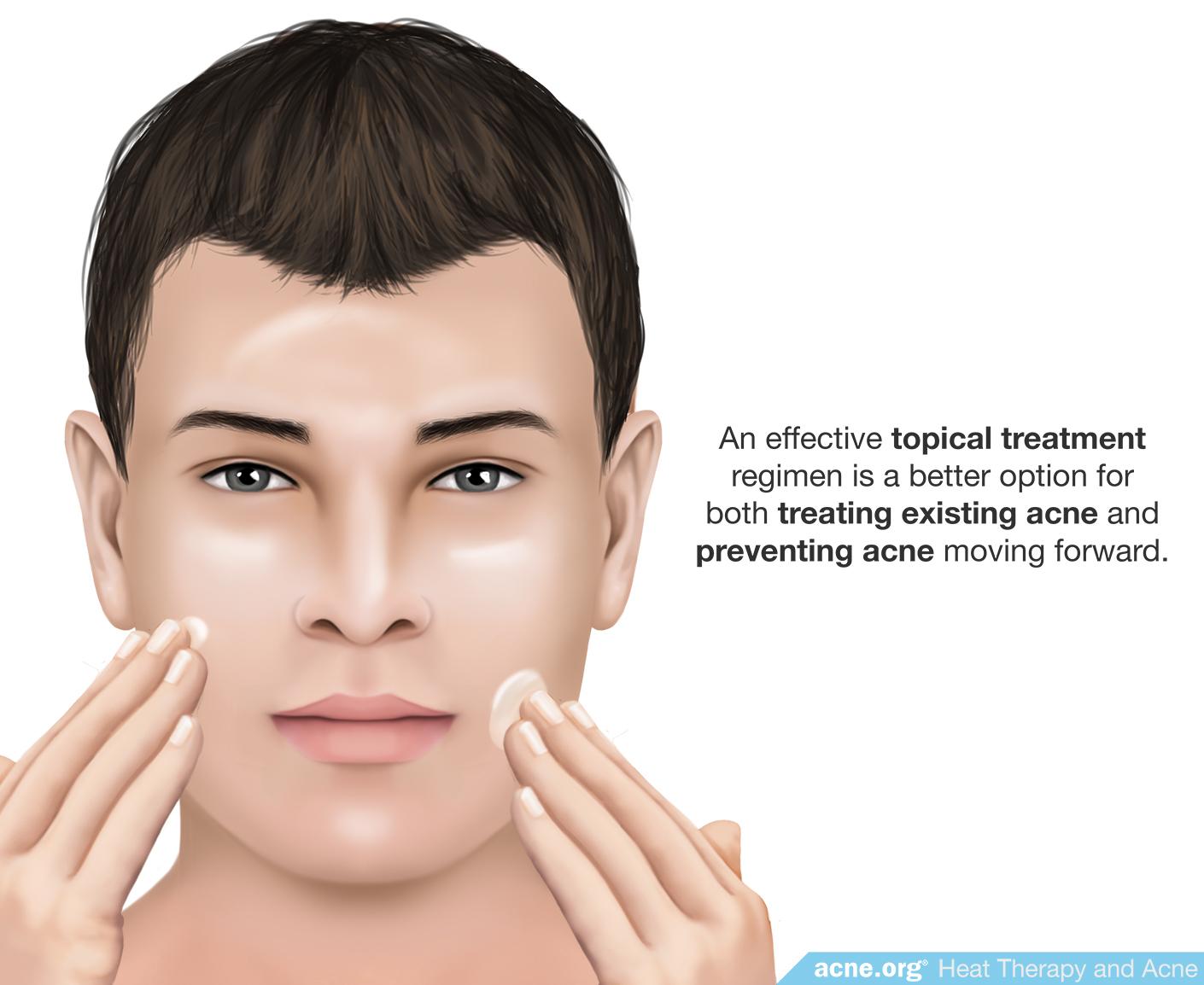 Effective Topical Treatment Better Than Heat Therapy for Acne