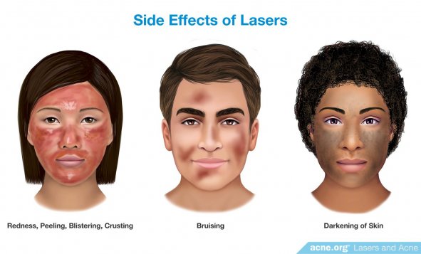 Side Effects of Lasers