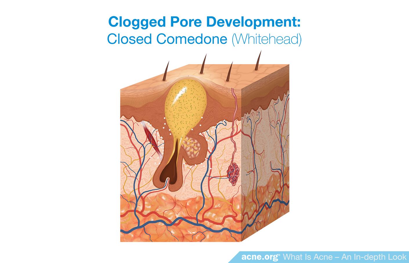 Clogged Pore Development: Comedone (Whitehead)