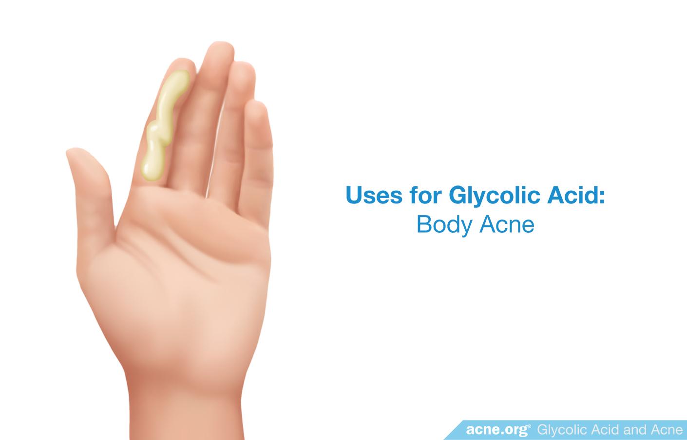 Uses for Glycolic Acid: Body Acne