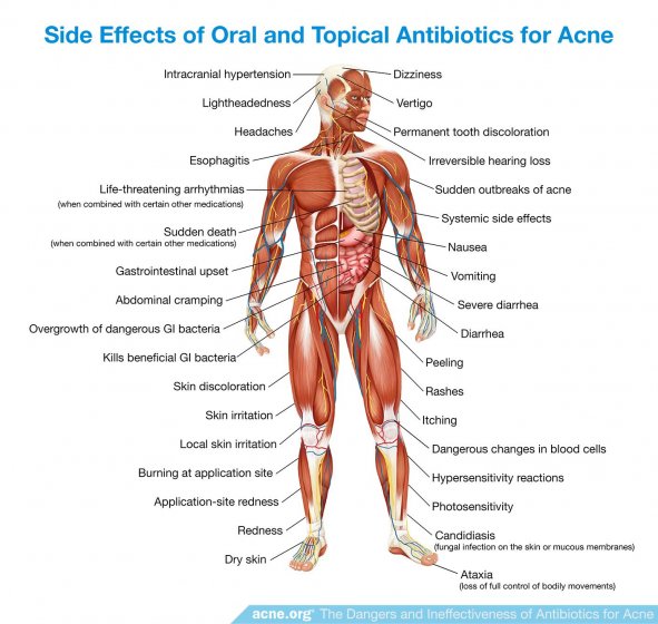 Side Effects of Oral and Topical Antibiotics for Acne