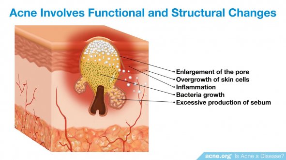 Acne Involves Functional and Structural Changes