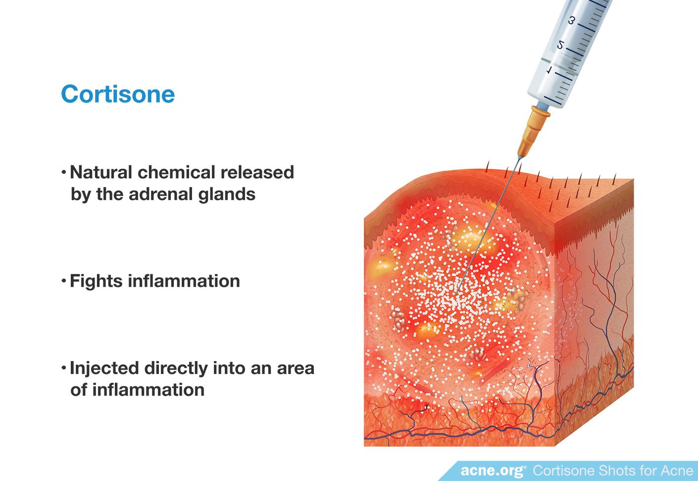 Cortisone Shots for Severe Acne Nodules and Cysts