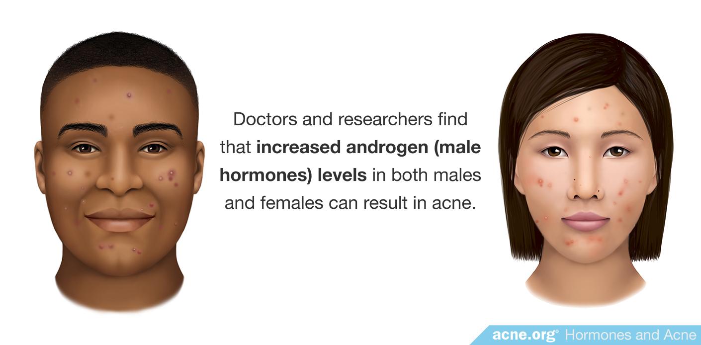 Increased Androgen Levels Can Result in Acne