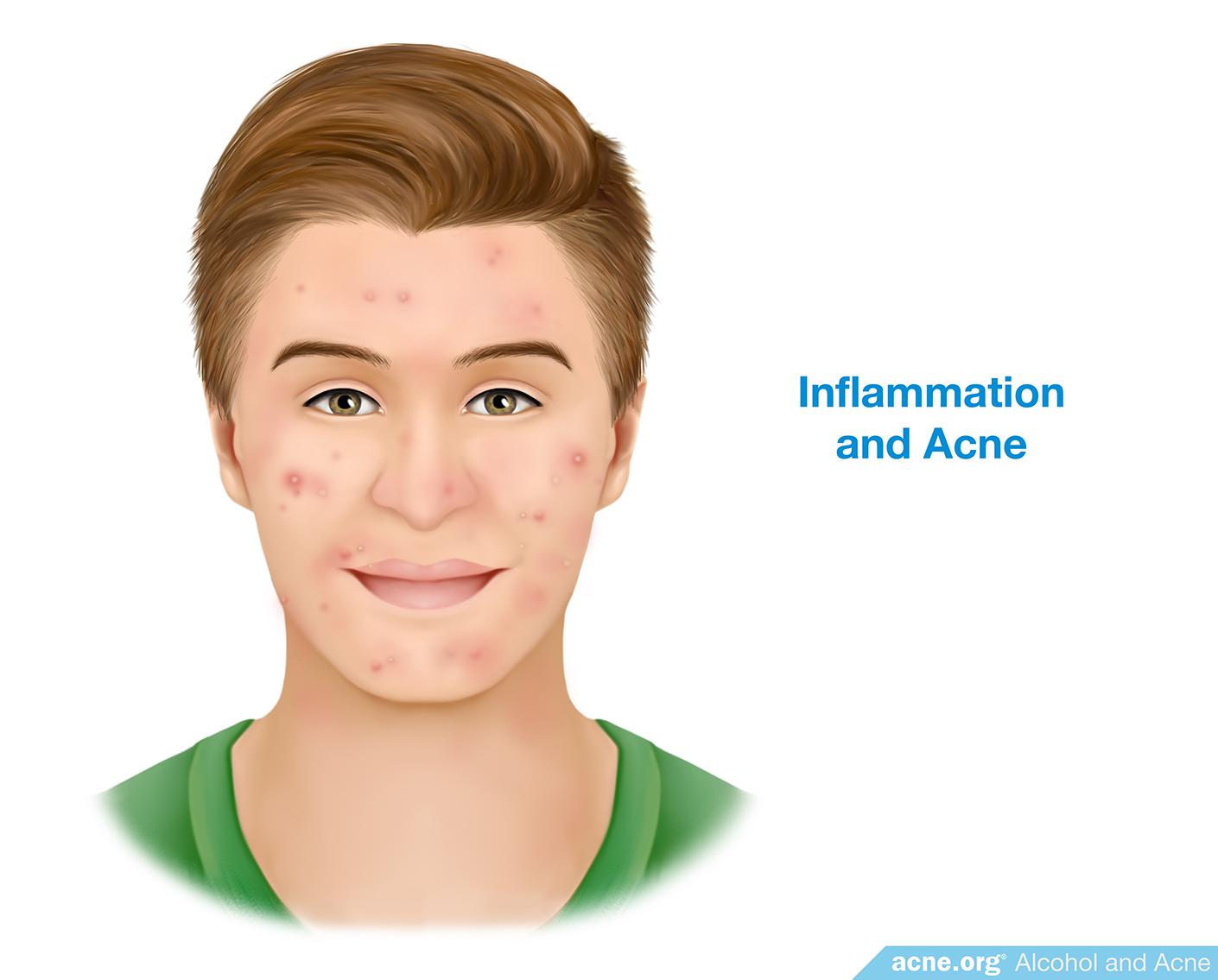 Inflammation and Acne