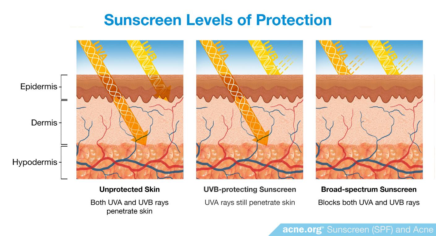 Sunscreen (SPF) and Acne Using Sunscreen (SPF) on Acneprone Skin