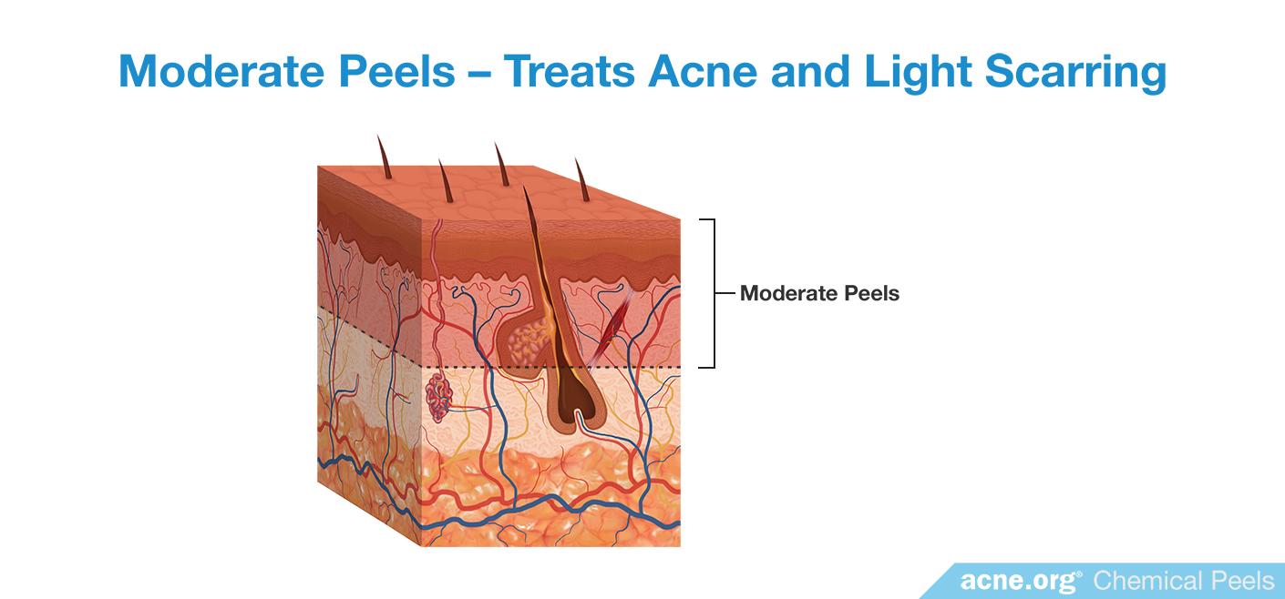Moderate Chemical Peels - Treat Acne and Light Scarring
