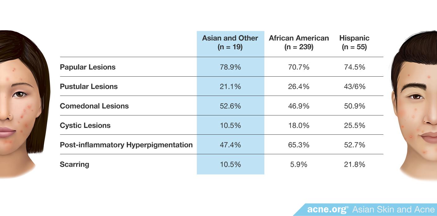 Types of Acne by Ethnicity