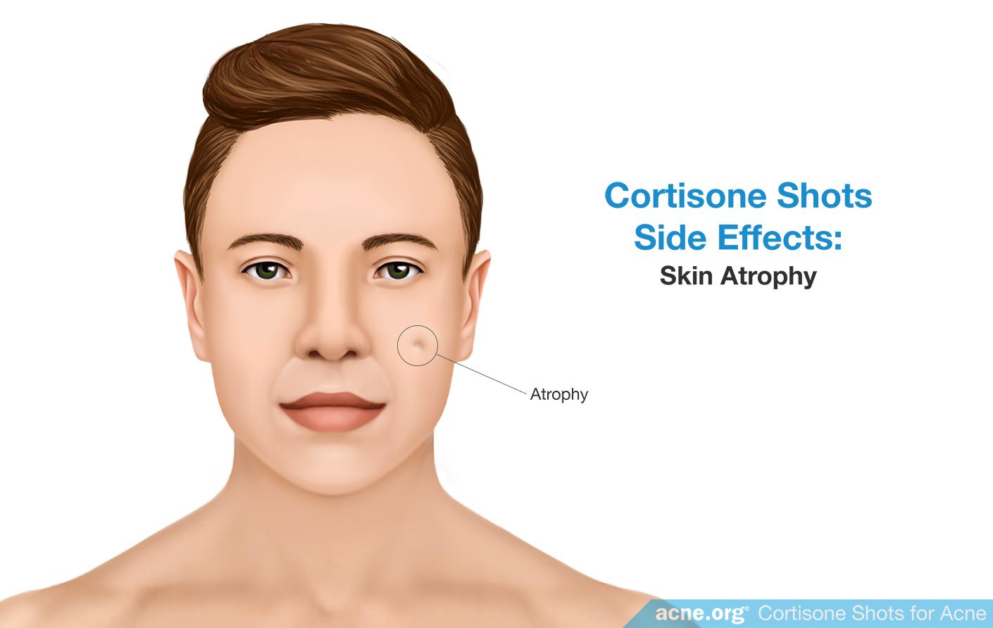 Cortisone Side Effects: Skin Atrophy