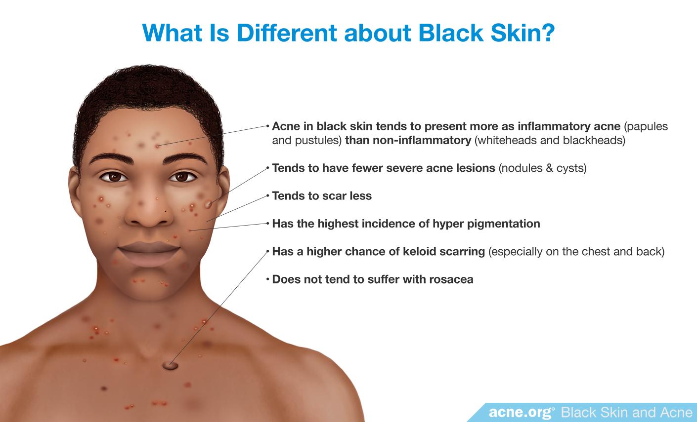 Treating Acne In Black Skin Acne