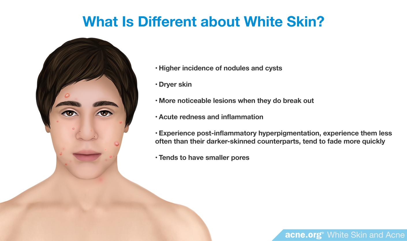 What Is Different about White Skin?