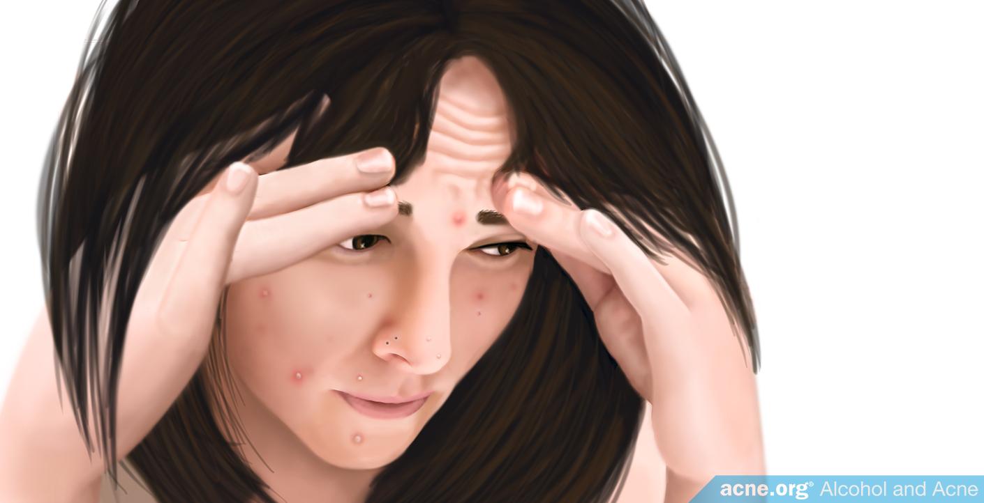 Alcohol and Acne