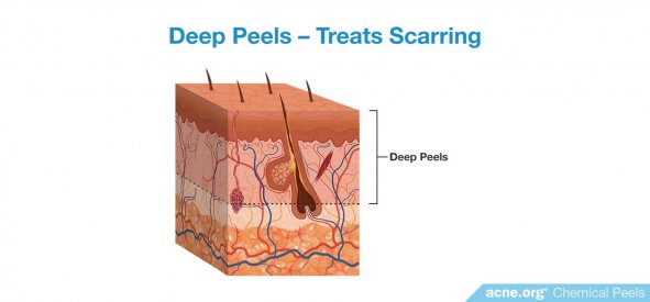 Deep Chemical Peels - Treat Scarring