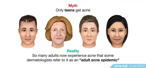 Myth: only teens get acne