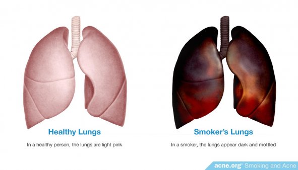 Does Smoking Cigarettes Cause Acne? - Acne.org