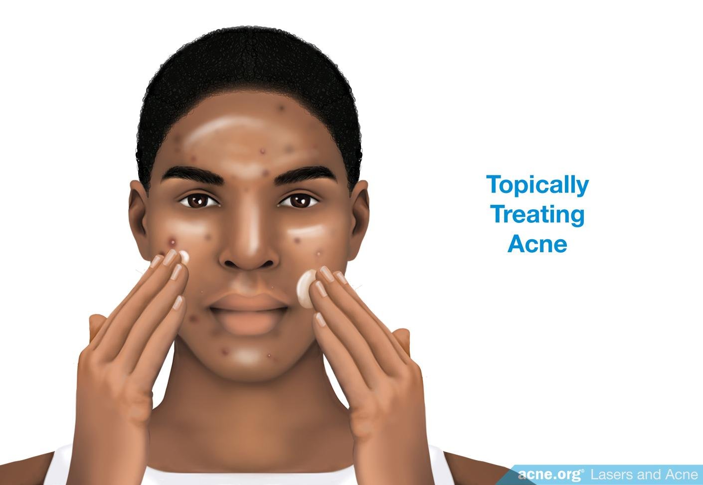 Treated mean. Black Skin in acne.