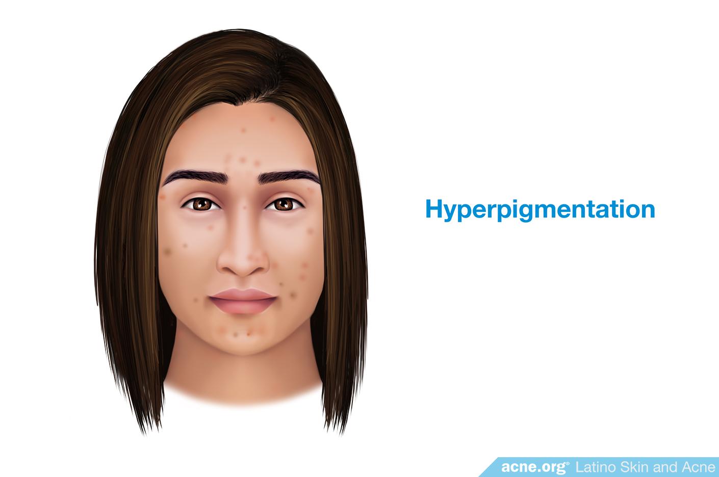 Hyperpigmentation