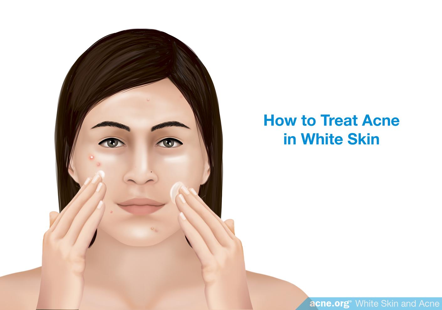 How to Treat Acne in White Skin