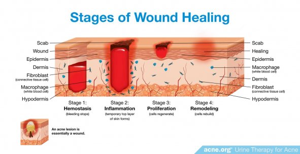 Stages of Wound Healing