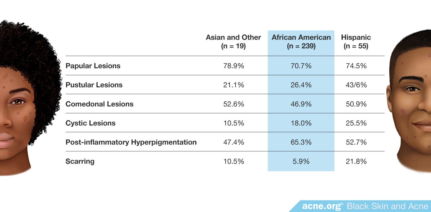 treating-acne-in-black-skin-acne